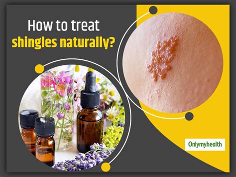 6 Useful Home Remedies For Shingles Treatment Onlymyhealth