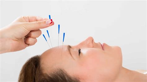 Acupuncture For Headaches And Migraines Northeast Spine And Sports Medicine