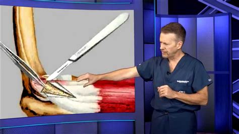 Other risk factors include, but are not limited to symptoms of tennis elbow include elbow pain that increases with activity, forearm and/or wrist pain, and loss of grip strength. Tennis Elbow Surgery - YouTube