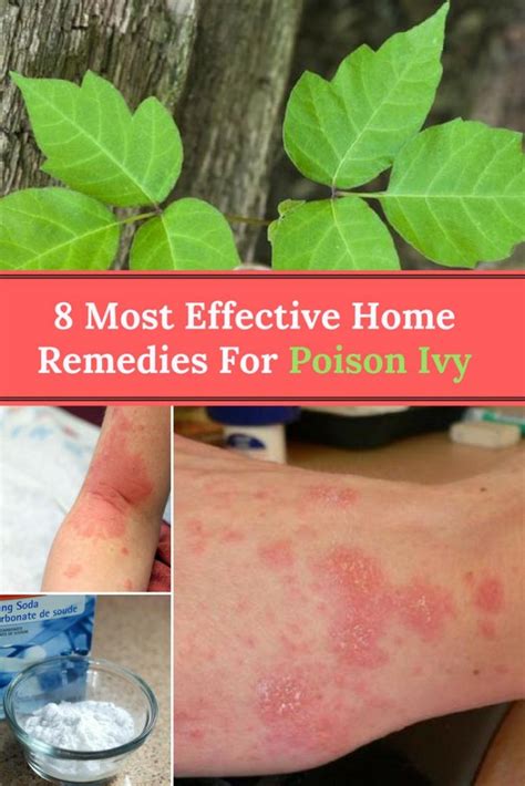 What Helps Cure Poison Ivy Fast