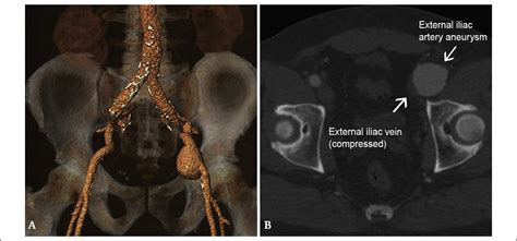 External Iliac Artery Aneurysm Causing Severe Venous Obstruction