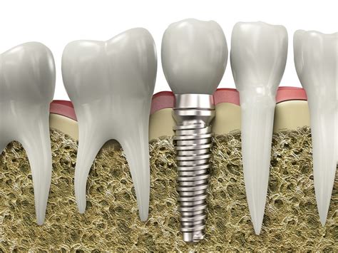 How Do Dental Implants Work Metro Dental Care