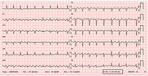 Ecg Showing Typical Atrial Flutter With Ventricular Rate At About 130