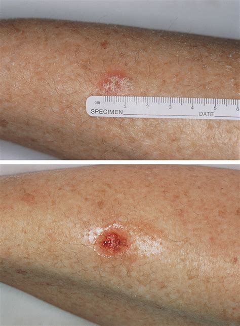 Treatment Of Superficial Basal Cell Carcinoma And Squamous Cell