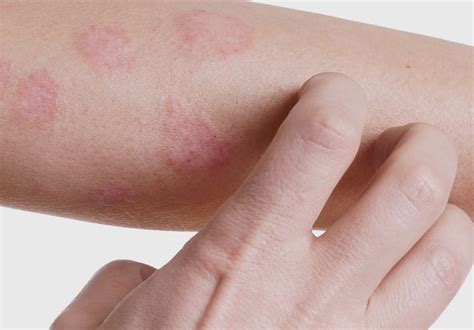 Dermatite At Pica Atinge Cerca De Das Crian As Raiox O Seu