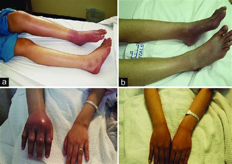Pictures Showing The Patient With Left Lower Limb Edema A Which