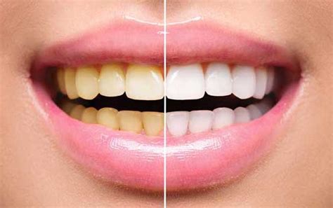Menjadikan Gigi Putih Bersih Tidak Harus Mahal Berikut Tipsnya