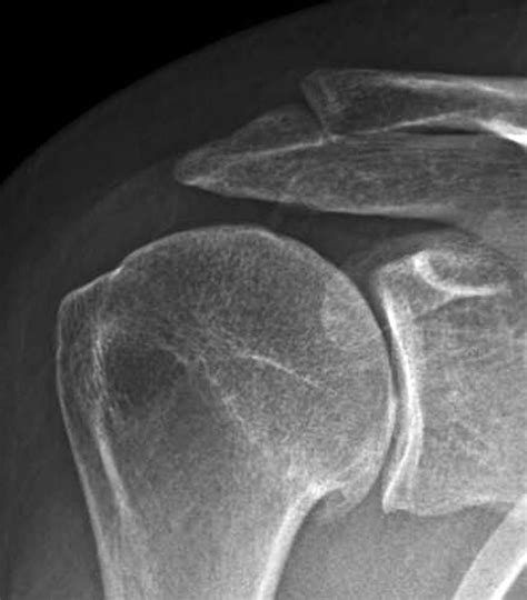 Uw Shoulder And Elbow Academy Shoulder Joint Replacement Arthroplasty