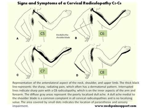 Neck Pain Resulting From A C5 C6 C7 Or C8 Radiculopathy Neck Pain