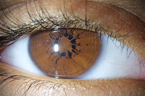 Persistierende Pupillarmembran Doccheck