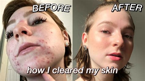 How I Cleared My Skin My Severe Acne Journey Photos And Videos