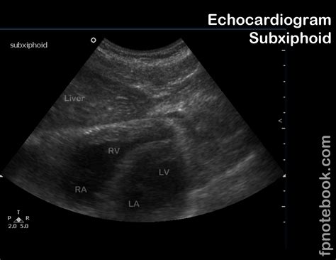 Subcostal Echocardiogram View