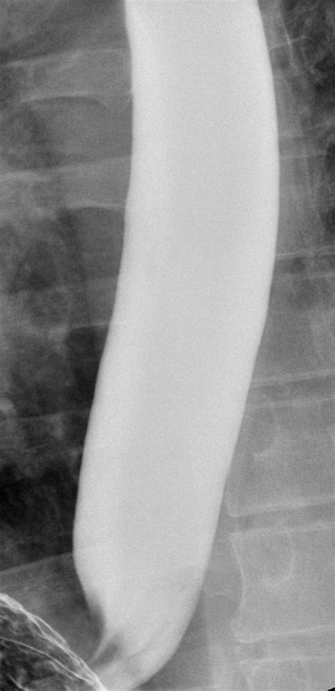 The Small Caliber Esophagus Radiographic Sign Of Idiopathic