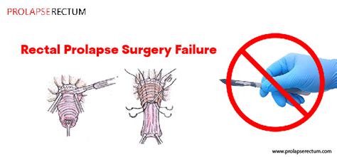 Rectal Prolapse Surgery Failure