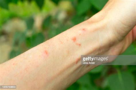 Poison Ivy Treatment Photos And Premium High Res Pictures Getty Images