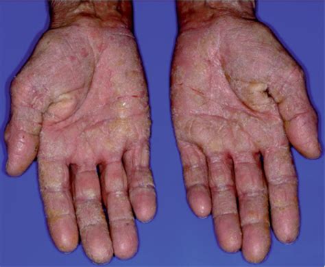 Chronic Hand Eczema Perception And Knowledge In Non Affected