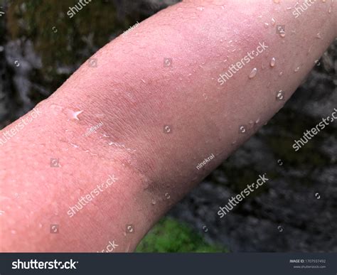 Acute Urticaria Red Rash Itch Symptoms Stock Photo 1707937492