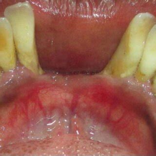Preoperative Before Periodontal Therapy For Treatment Of Aggressive