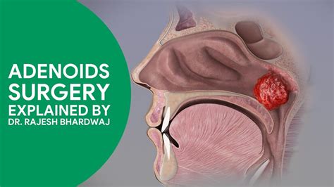 Adenoid Surgery By Dr Rajesh Bhardwaj Adenoidectomy