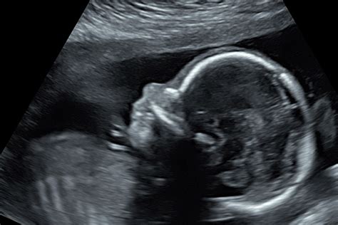 Fetal Ultrasound Technique Does Not Improve Prediction Of Small For