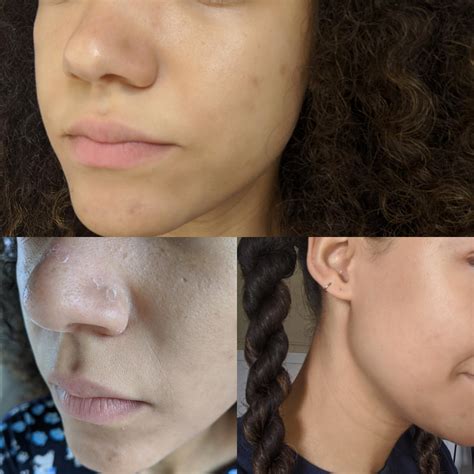 How To Treat Hyperpigmentation With Tretinoin Justinboey