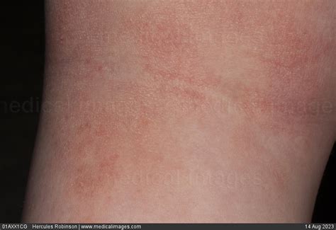 Stock Image Dermatology Atopic Eczema Erythematous And Dry Scaly Skin