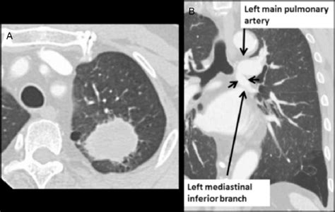 A Chest Ct Shows Lung Mass In The Left Upper Lobe B Chest