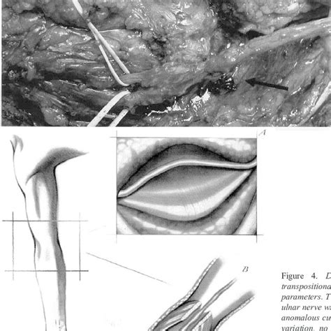 Drawings Representing The Modified In Situ Decompression Technique The