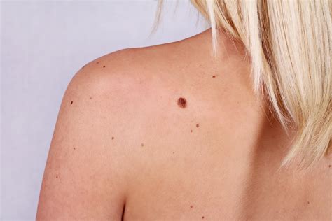 Margins Developed For Skin Removal Around Suspicious Moles Scot