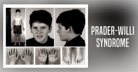 What Is Prader Willi Syndrome