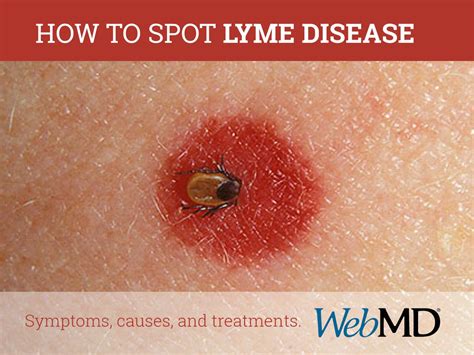 Lyme Disease Symptoms Causes Diagnosis Treatment Prevention Lyme