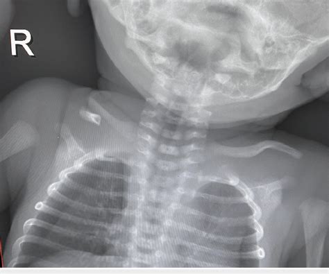 X Ray Demonstrating Congenital Pseudarthrosis Of The Right Clavicle