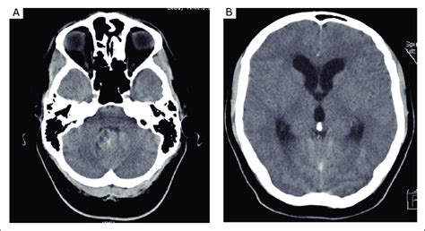 Contrast Enhanced Ct Revealing A Lesion In The Fourth Ventricle A