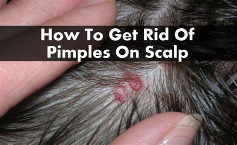 How To Get Rid Of Pimples On Scalp Find Home Remedy And Supplements