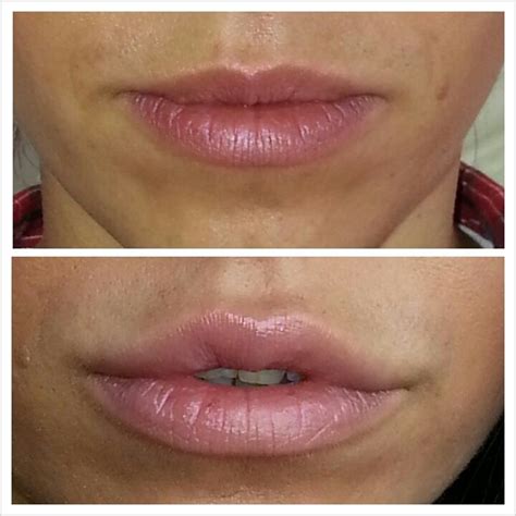 Lip Augmentation With Hyaluronic Acid Lip Augmentation Aesthetic