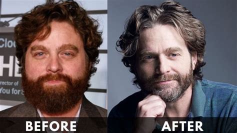 Zach Galifianakis Weight Loss [2024] Before And After