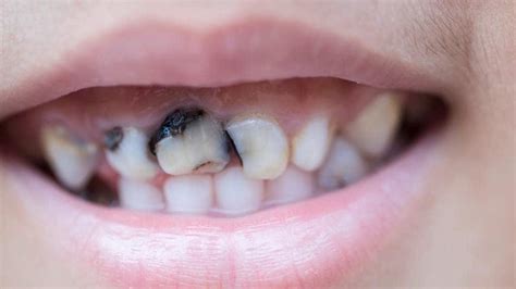 6 Kebiasaan Buruk Yang Menyebabkan Gigi Anak Menjadi Berlubang Pepsodent