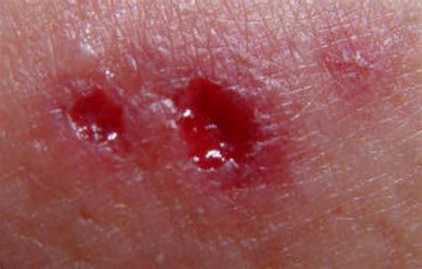Wolf Spider Bite What You Need To Do Hubpages