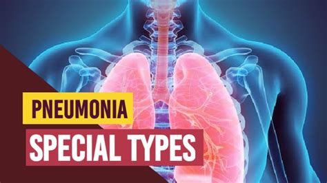 Icu Chest 10 Pneumonia Special Types Pneumonia In