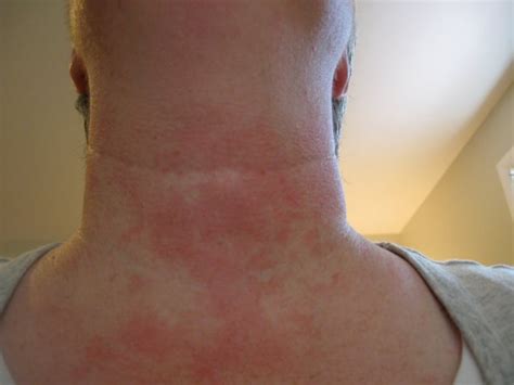 Neck Rashes Pictures Pictures Photos