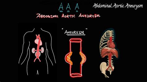 Aneurysm Abdominal Aortic Aneurysm Youtube