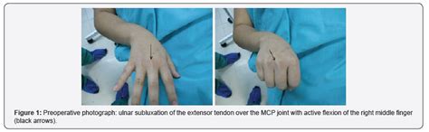 Surgical Stabilization Of The Extensor Tendon Dislocation In Non