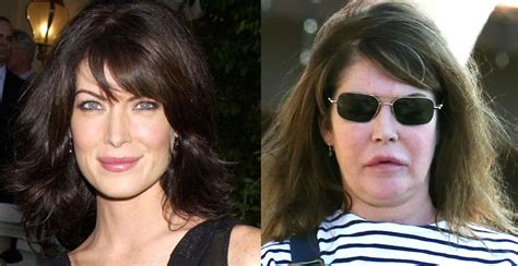 10 Of The Most Unfortunate Cases Of Plastic Surgery In Hollywood