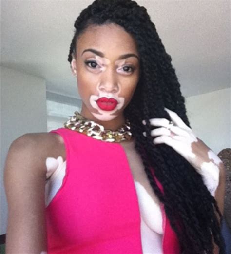 Once Bullied For Her Rare Skin Condition Chantelle Brown