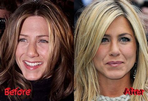 Jennifer Aniston Before And After Nose Job