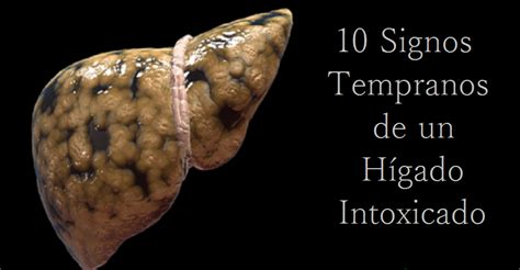 Síntomas del Hígado Graso intoxicado Cómo Limpiar la grasa del Hígado