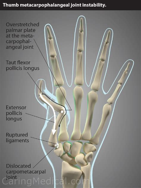 Non Surgical Alternatives For Thumb Osteoarthritis Caring Medical Florida