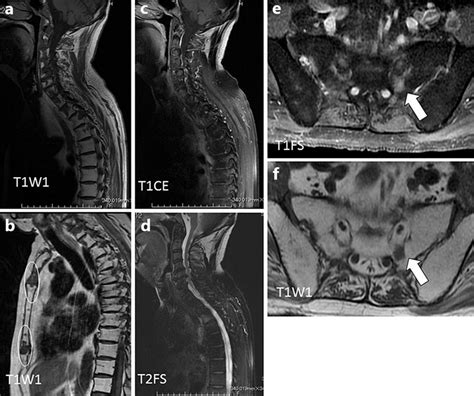 Sagittal T1 Weighted Mri Of The Cervical And Thoracic Spine A And