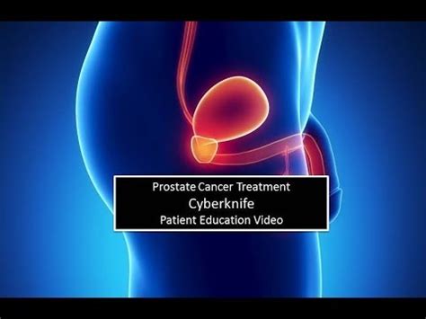 Prostate Cancer Treatment Pasadena Cyberknife YouTube