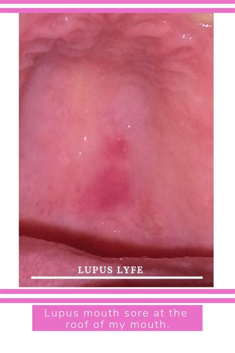 Lupus Mouth Sores Lupus Lyfe In 2020 Mouth Sores Roof Of Mouth